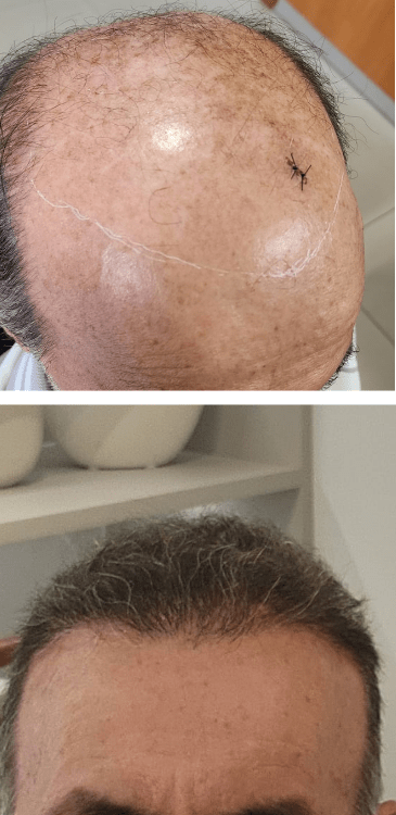 Transplante capilar - Dr Paulo Campos