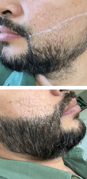 Transplante capilar - Dr Paulo Campos